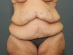 ABDOMINOPLASTY FOLLOWING SIGNIFICANT WEIGHT LOSS : Case 79 Before